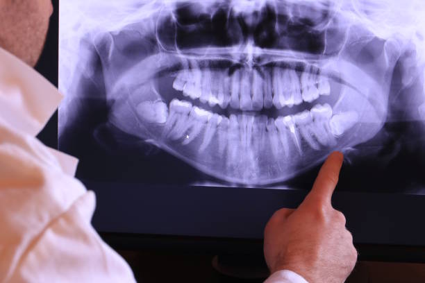 Best Emergency Treatment for Dental Infections or Abscesses in Pacheco, CA